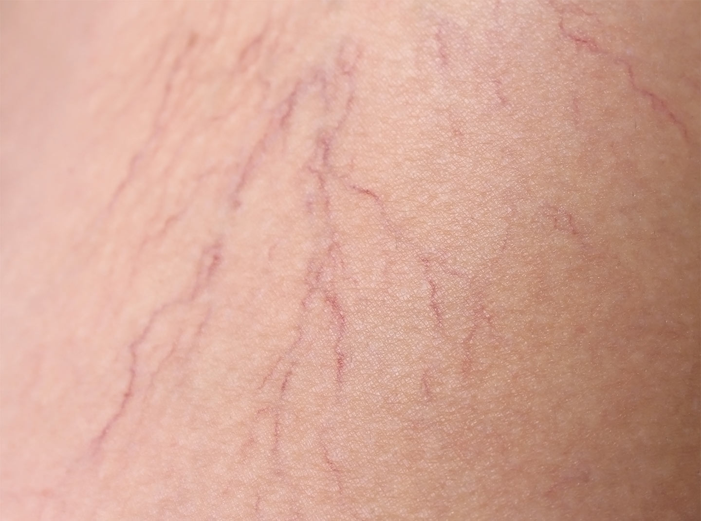 Fine Spider Veins treatment in Auckland